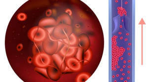 Risiko dan Manfaat Direct Oral Anticoagulant Versus Warfarin pada Kondisi Nyata: Studi Kohort di Pelayanan Kesehatan Primer – Telaah Jurnal Alomedika