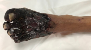 Autoamputasi vs Operasi Amputasi pada Kaki Diabetik dengan Gangren Kering