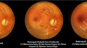 Skrining Retinopati Diabetik: Kapan dan Bagaimana?