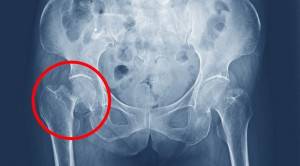 Manajemen Nyeri Fraktur Collum Femur – Blok Saraf Perifer vs Blok Neuroaxial