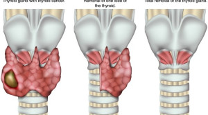 Untung Rugi Operasi Transoral Endoscopic Thyroidectomy via Vestibular Approach (TOETVA)