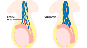 Terapi Subfertilitas akibat Varikokel: Bedah atau Terapi Radiologis