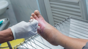 Efek Obat Regulator Makrofag pada Penyembuhan Ulkus Diabetikum - Telaah Jurnal Alomedika