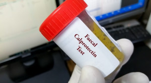 Pemeriksaan Fecal Calprotectin untuk Membedakan Inflammatory Bowel Disease dan Irritable Bowel Syndrome