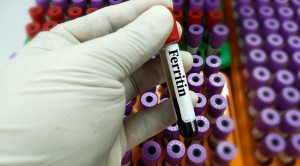 Peran Ganda Feritin sebagai Reaktan Fase Akut Inflamasi pada Defisiensi Besi