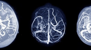 Aneurisma Intrakranial Tidak Ruptur: Konservatif atau Operatif