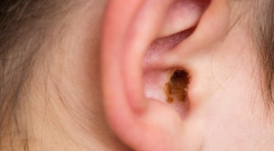 Efikasi Antifungal Topikal Pada Penanganan Otomikosis