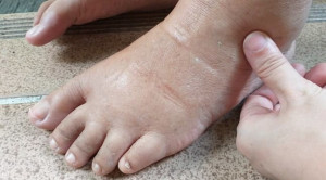 Red Flag Edema Perifer