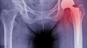 Keuntungan Blok Saraf Perifer pada Pasien dengan Fraktur Panggul