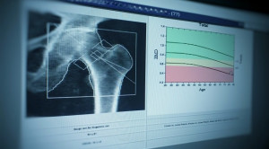 Suplementasi Kalsium dan Vitamin D3 untuk Mencegah Osteoporosis pada Pasien dengan Terapi Kortikosteroid Jangka Panjang