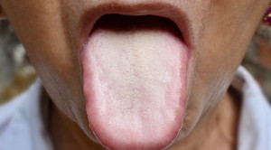 Tata Laksana Kandidiasis pada Populasi Geriatri