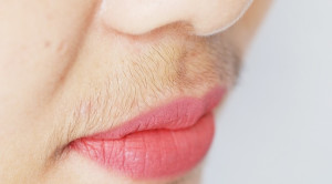 Red Flags Hirsutism