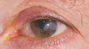 Perbedaan Klinis antara Keratitis Bakteri dan Jamur