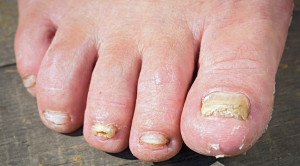 Tinea Unguium pada Geriatri