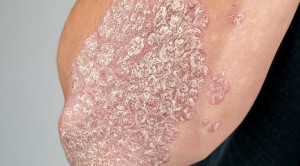 Secukinumab Efektif untuk Terapi Psoriasis Vulgaris Derajat Sedang-Berat