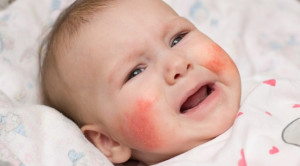 Manajemen Alergi Susu Sapi pada Bayi