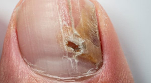 Terapi Profilaksis Rekurensi Tinea Unguium