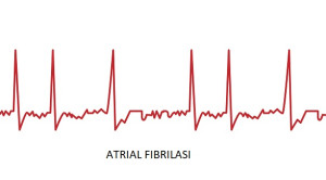 Hubungan Pemberian Kalium dan Magnesium Intravena dengan Konversi Atrial Fibrilasi