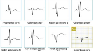 Makna Klinis Fragmented QRS