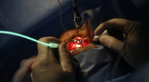 Manfaat Vitrektomi Dini untuk Perdarahan Vitreus