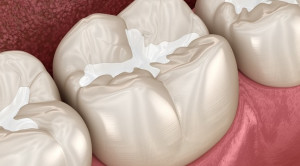 Perkembangan Dental Sealant dalam Mencegah Karies Gigi