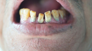 Faktor Penyebab dan Cara Pencegahan Erosi Gigi