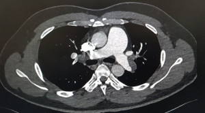 Peran PERC Rule untuk Mengeliminasi Diagnosis Emboli Paru