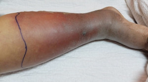 Selulitis vs Limfedema