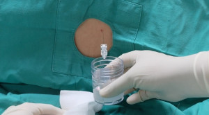 Peran Pungsi Lumbal dalam Diagnosis Perdarahan Subaraknoid