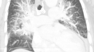 Kombinasi Diuretik Thiazide dengan Loop Diuretic pada Terapi Gagal Jantung Dekompensata – Telaah Jurnal Alomedika