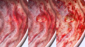 DLBS2411 sebagai Gastroprotektor dan Terapi Ulkus Peptikum Tanpa Perdarahan