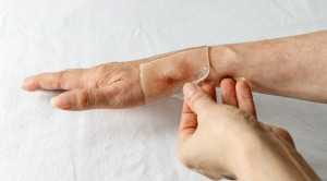 Pencegahan Keloid dengan Lembaran Gel Silikon