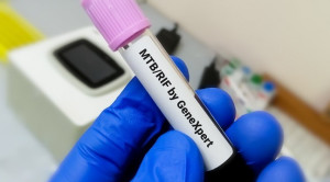 TCM atau Tes Cepat Molekuler untuk Diagnosis Tuberkulosis