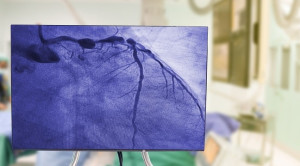 Perbandingan Kondisi Nyata Penggunaan Clopidogrel, Prasugrel, dan Ticagrelor pada Percutaneous Coronary Intervention (PCI) Primer – Telaah Jurnal Alomedika