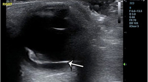 Point-of-Care Ultrasonography untuk Diagnosis Ablatio Retina