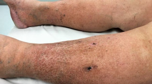 Terapi Nonfarmakologis pada Insufisiensi Vena Kronis