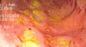 Terapi Induksi Dan Rumatan Upadacitinib Pada Penyakit Crohn – Telaah Jurnal Alomedika