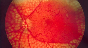 Terapi Laser VS Anti-Vascular Endothelial Growth Factor pada Retinopati Diabetik
