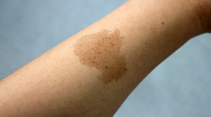 Mengenal Beberapa Jenis Birthmark