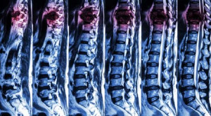Tata Laksana Awal Spinal Cord Injury Berdasarkan Panduan American College of Surgeons 2022