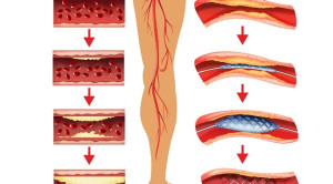 Perbandingan Resorbable Scaffold dan Angioplasti pada Penyakit Arteri Infrapopliteal – Telaah Jurnal Alomedika