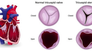 Transcatheter Edge to Edge Repair (TEER) untuk Pasien Regurgitasi Trikuspid – Telaah Jurnal Alomedika