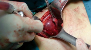 Salpingectomy untuk Pencegahan Primer Kanker Ovarium