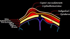 Penanganan Perdarahan Subgaleal pada Neonatus