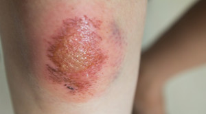 Pentingnya Hidrasi pada Perawatan Luka untuk Mencegah Bekas Luka