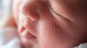 5 Lesi Kulit pada Neonatus