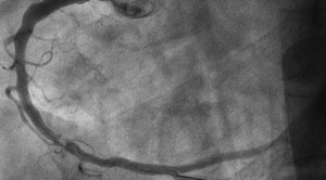 Angioplasti Tidak Lagi Direkomendasikan untuk Penyakit Arteri Koroner Stabil