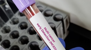 Validasi Klinis Targeted Methylation-Based Multi-Cancer Early Detection (MCED) Test – Telaah Jurnal Alomedika