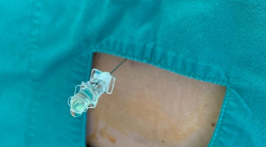 Posisi Pungsi Lumbal Terbaik pada Bayi