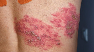 Lesi Herpes Zoster pada Lansia Tidak Khas Vesikel